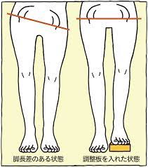 足の長さ同じですか！？骨盤矯正・姿勢矯正で改善できますよ★