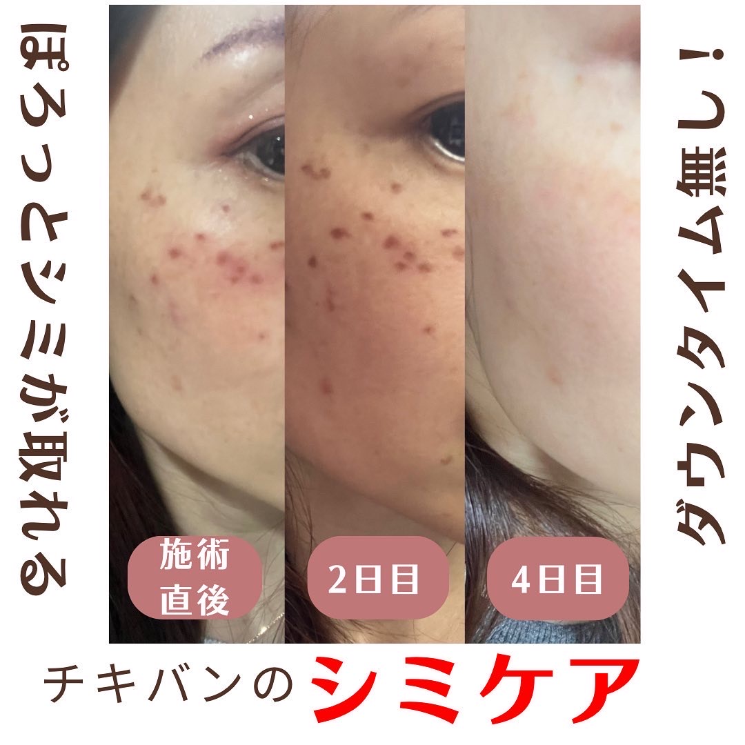 チキバンの安心安全シミケアしながらお肌のも綺麗に♪