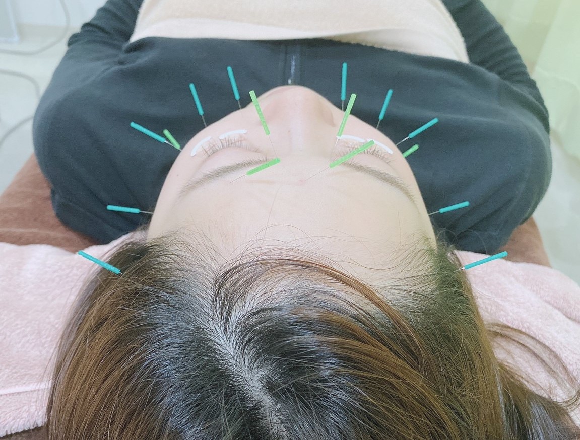 美容鍼とターンオーバー