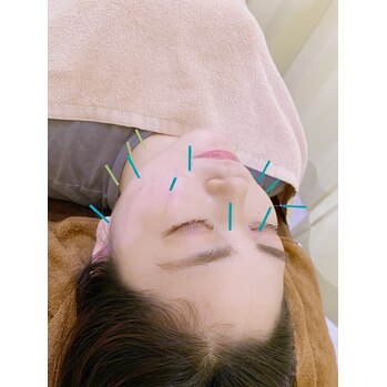 美容鍼でアンチエイジング
