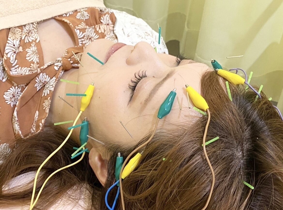 肌本来の力を引き出す美容鍼とは？