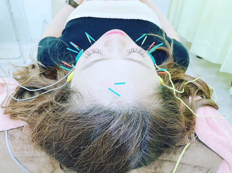 美容鍼の秘密！