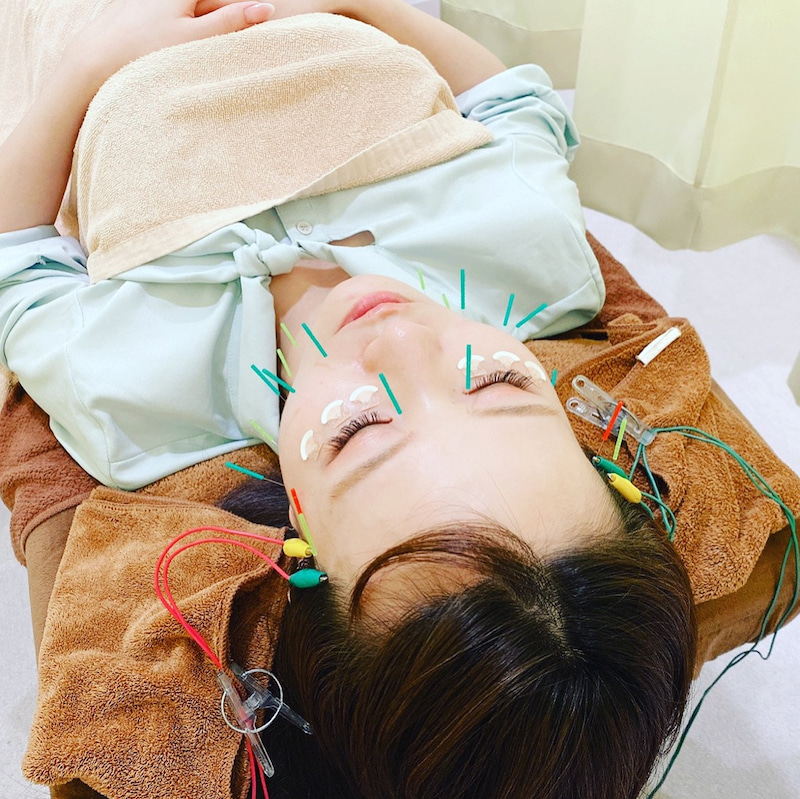 美容鍼を受ける方、増えてきています♪♪