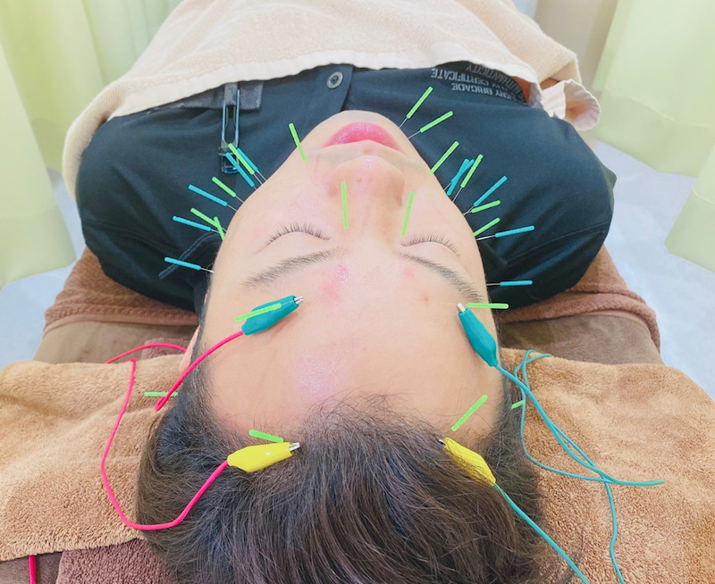 鍼追加できます★激しい美容鍼のお求めの方必見！！