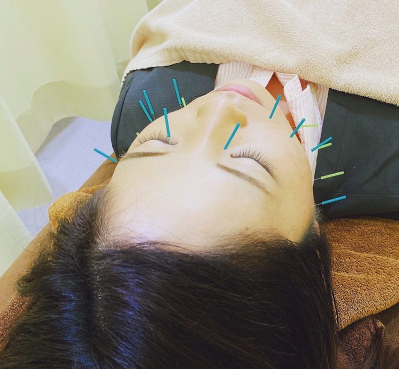 美容鍼あるある♪