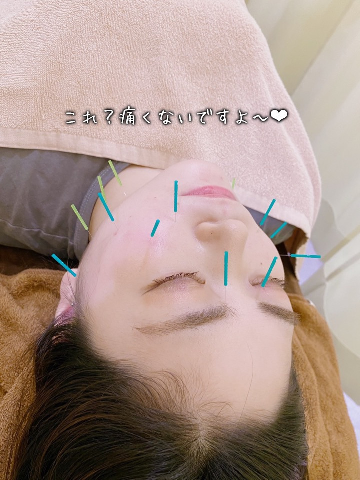 美容鍼は痛くない！気持ちいいんです！小顔効果◎