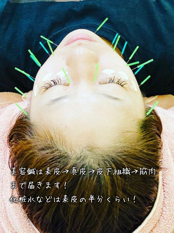 美容鍼は表皮、真皮、皮下組織を通って筋肉まで刺激しているから効果があるのです！！