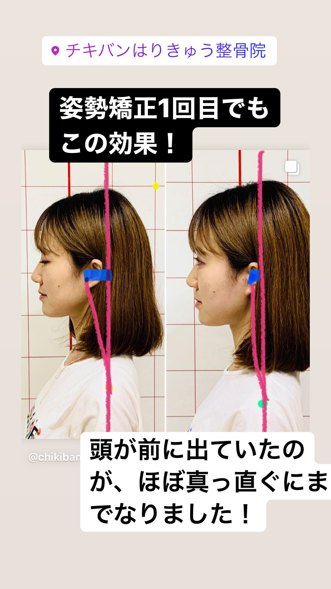 姿勢矯正でこんなにも変化が！！